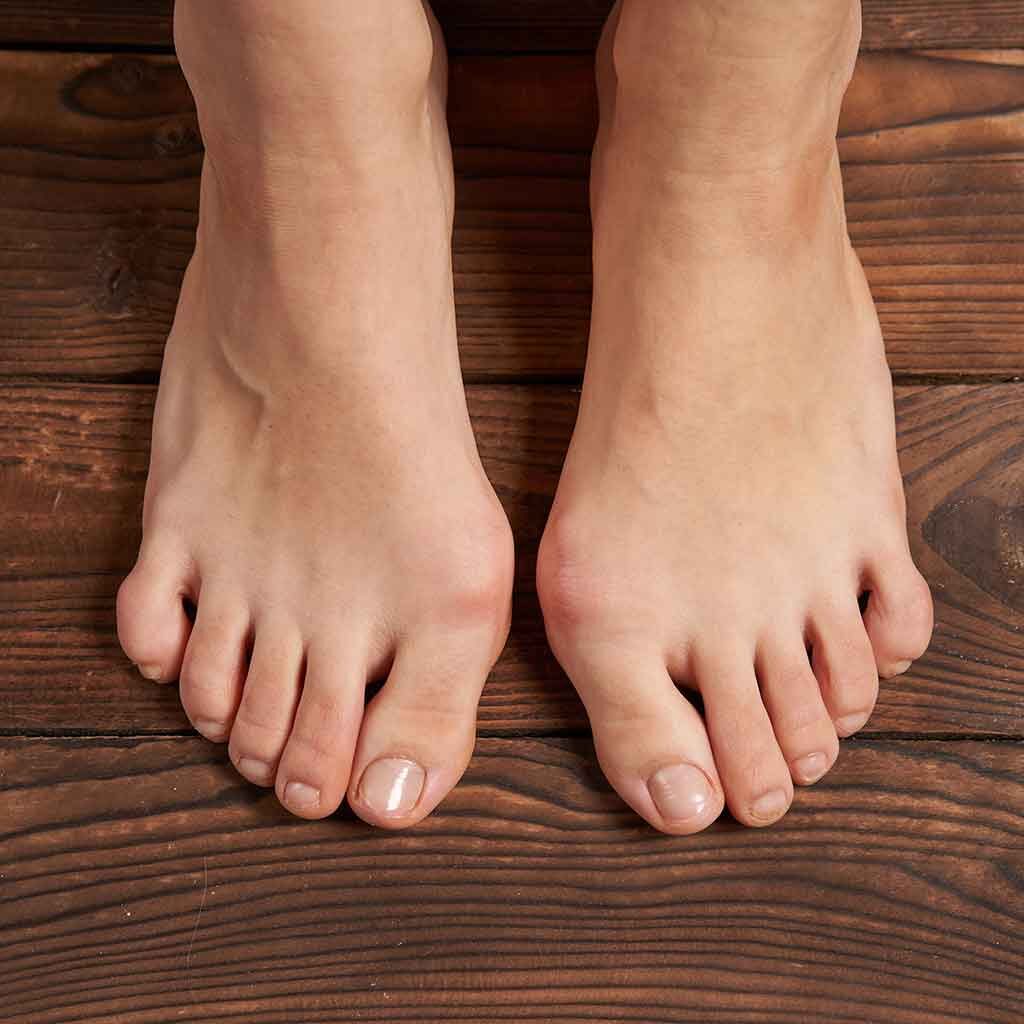 Hammer Toe Treatment — New York Foot Health, NYSPMA