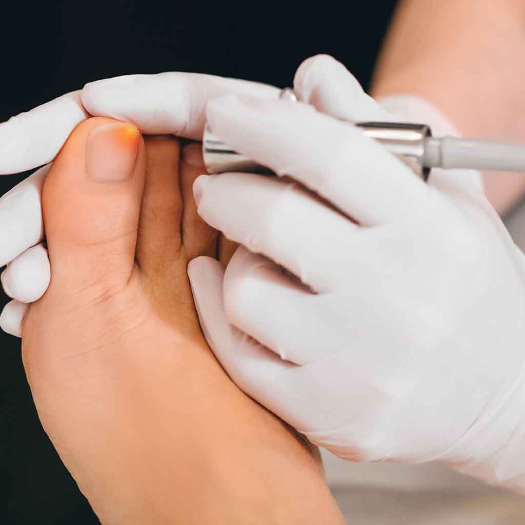 Hammer Toe Treatment — New York Foot Health, NYSPMA