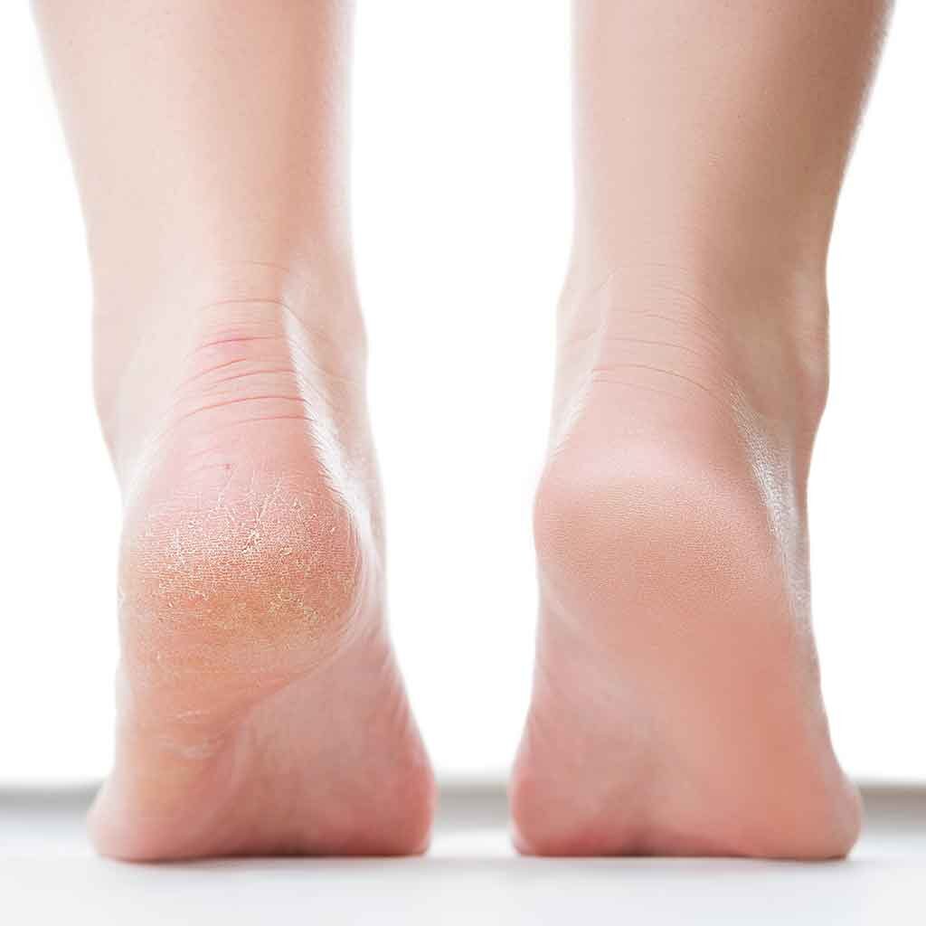 Tarsal Tunnel Syndrome - Burning and Numbness Heel