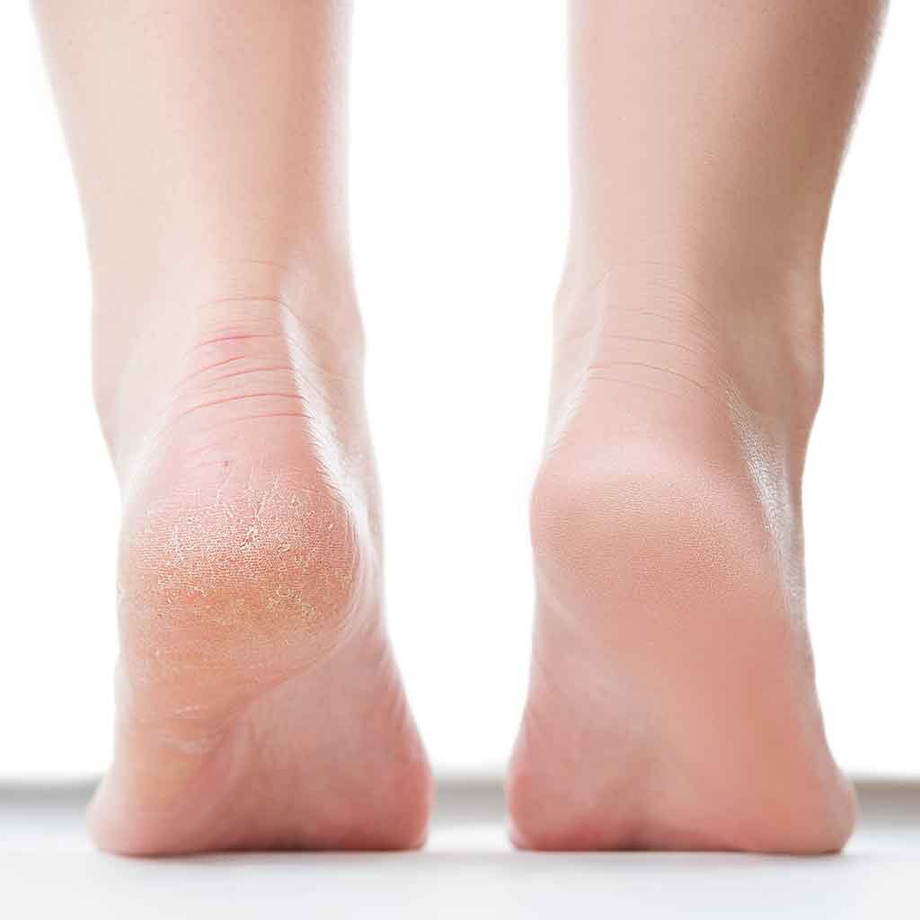 Heel pain cure on sale treatment