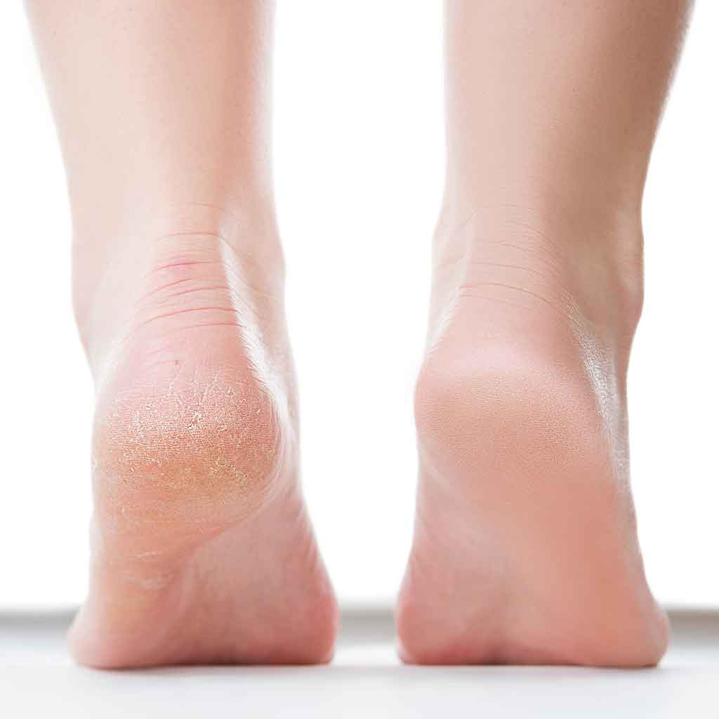 Got Heel Pain? The Top 3 Reasons for Pain While Walking